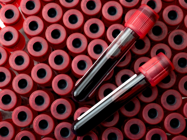 Personal training for business owners at 5th Element Wellness in Fitzroy North, showing blood sample vials used for optional nutritional blood chemistry analysis and health insights.